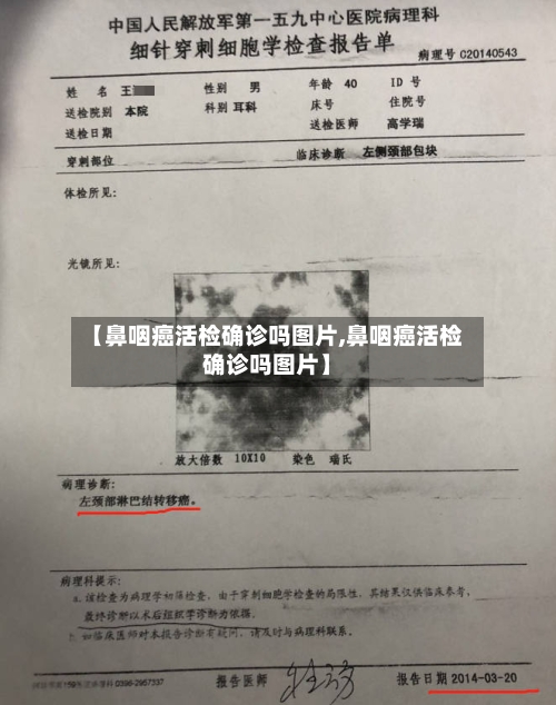 【鼻咽癌活检确诊吗图片,鼻咽癌活检确诊吗图片】-第3张图片